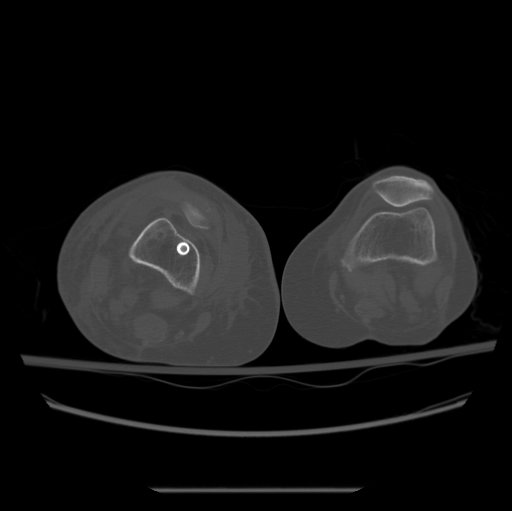 Femoral Nail Malrotation CT 2